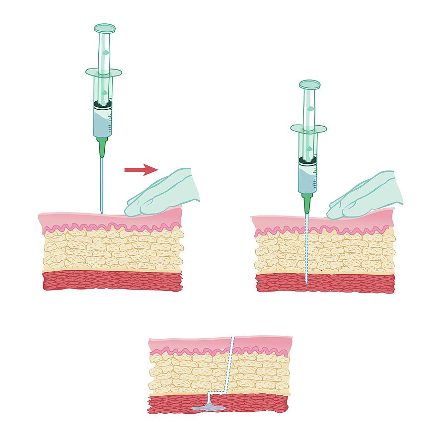 im injection im injection