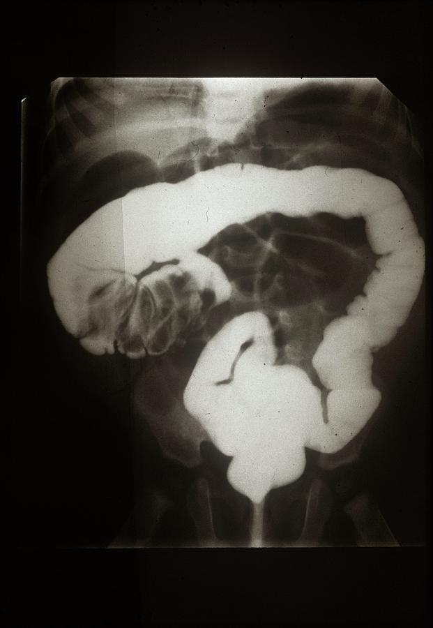 Black And White Photograph - Intussusception Of The Intestines by Cnri/science Photo Library