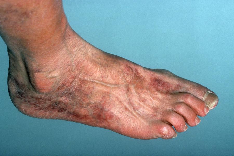 Ischemia Of The Foot Photograph by St Bartholomew Hospital/science ...