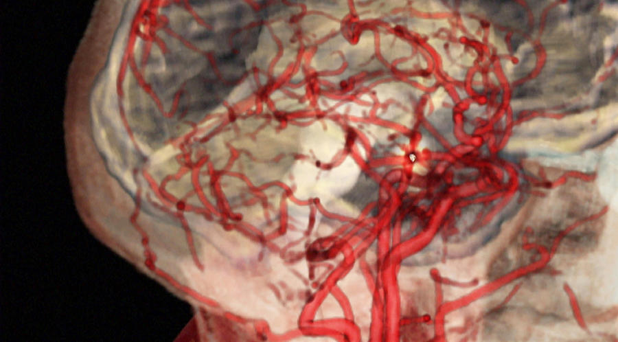 Ischemic Stroke, Lateral View Photograph by Anatomical Travelogue