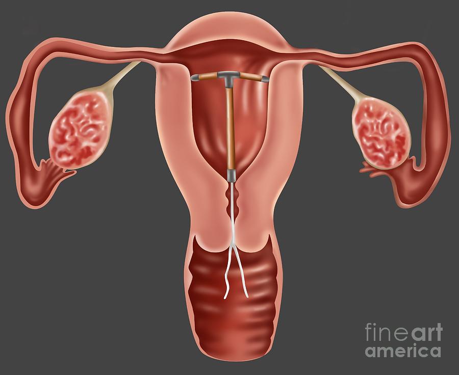 Iud Contraceptive Photograph By Gwen Shockey Pixels