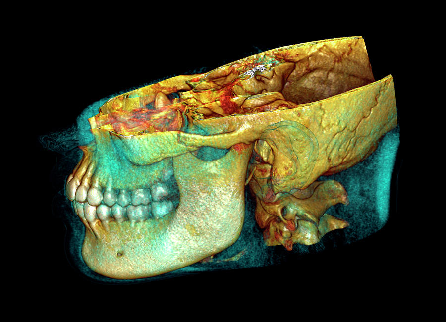 Jaw Bones Photograph by Antoine Rosset/science Photo Library