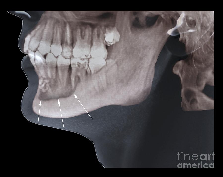 Jaw Tumour, Ct Scan Photograph by Zephyr