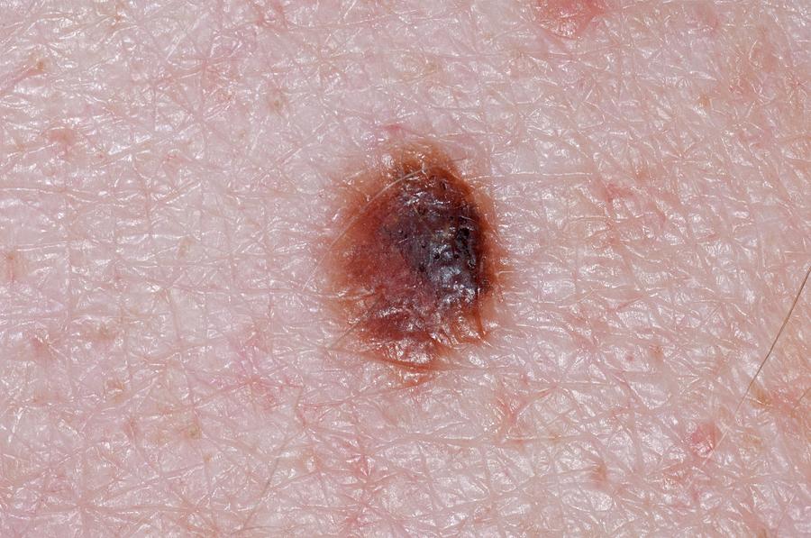 Junctional Mole (naevus) On The Skin Photograph by Dr P. Marazzi ...