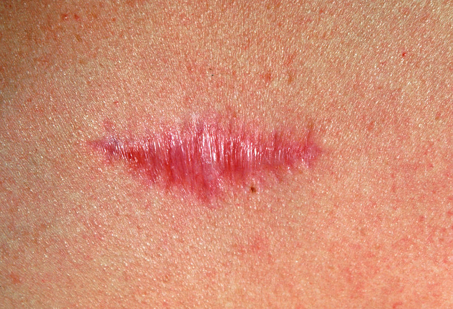 After Surgery Photograph - Keloid Scar by Gary Parker/science Photo Library