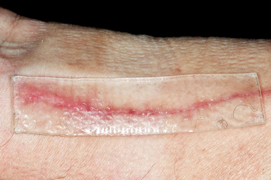 Keloid Scar Treatment Photograph by Dr P. Marazzi/science Photo Library