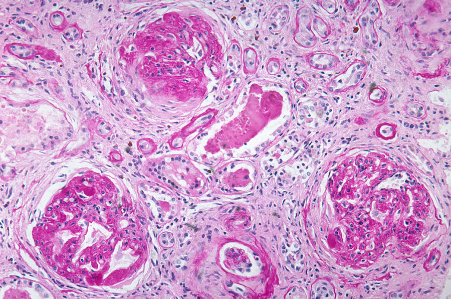 Kidney, Amyloid Deposits, Lm Photograph by Michael Abbey