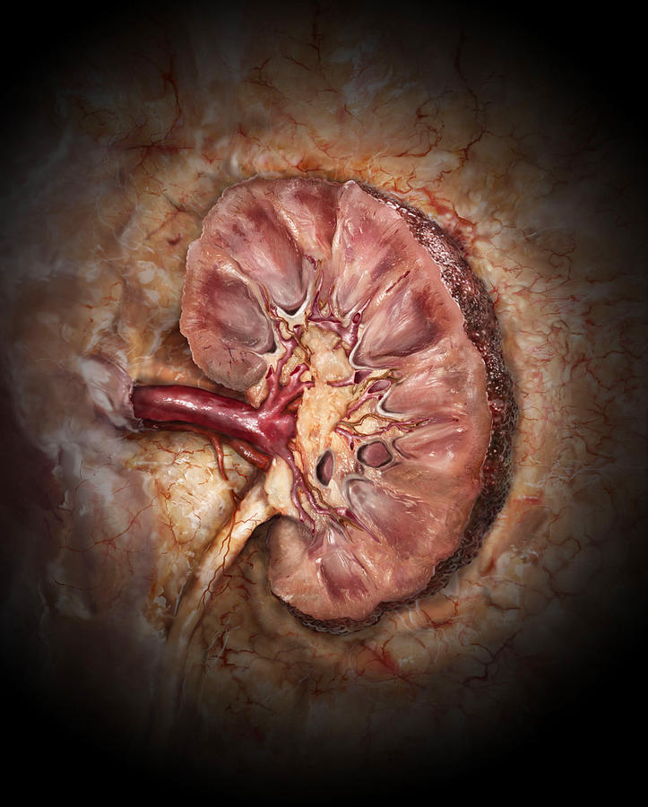 Kidney Disease, Coronal Section Photograph by Anatomical Travelogue