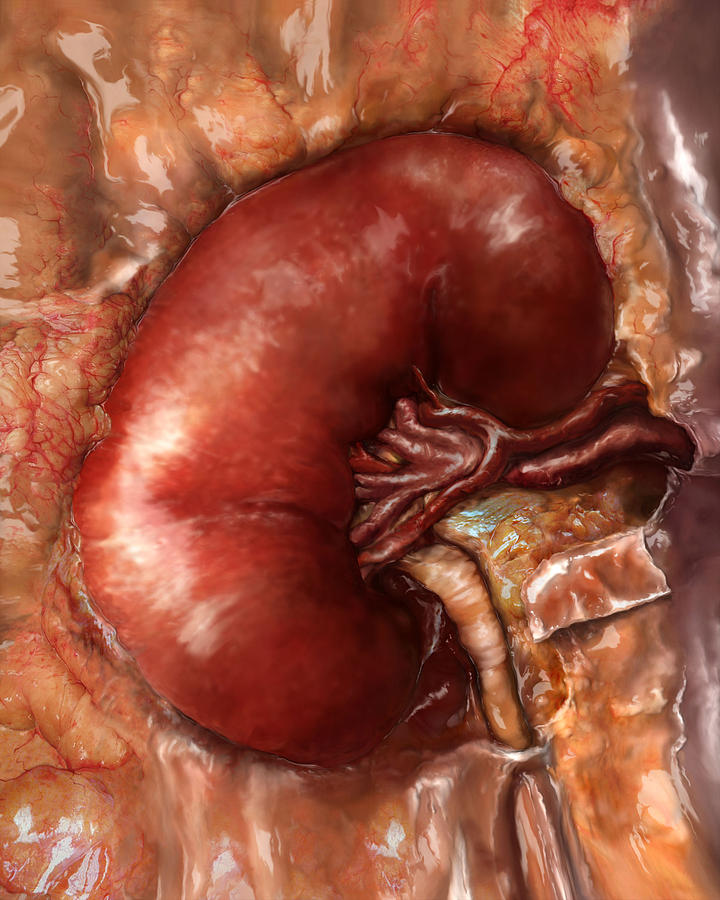 Kidney Disease Progression, Healthy Photograph by Anatomical Travelogue