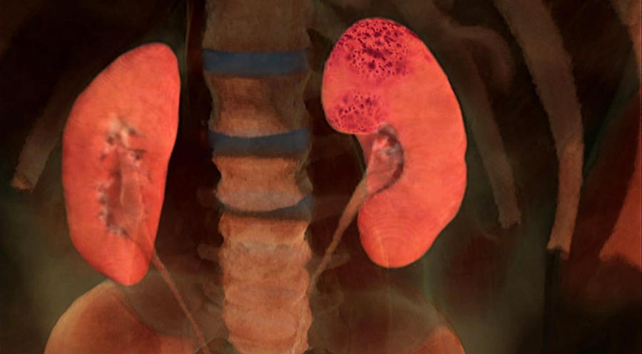 Kidney Failure Photograph by Anatomical Travelogue