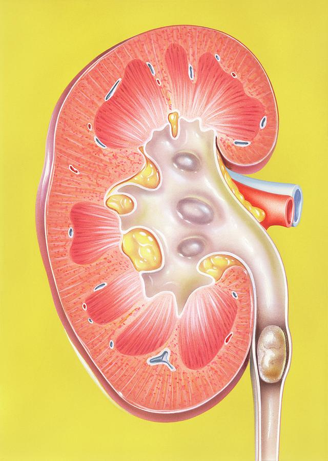 kidney stones in kidney