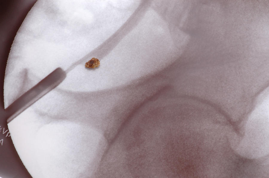 Kidney Stone Positioned on X-ray Photograph by Choicegraphx