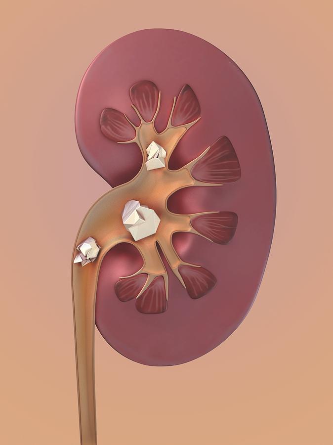 Kidney Stones Artwork Photograph By Science Photo Library Pixels