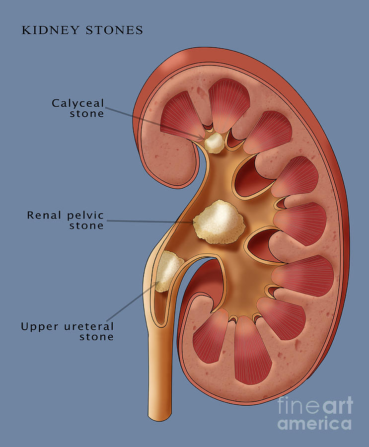 Kidney Stones, Illustration Photograph by Monica Schroeder