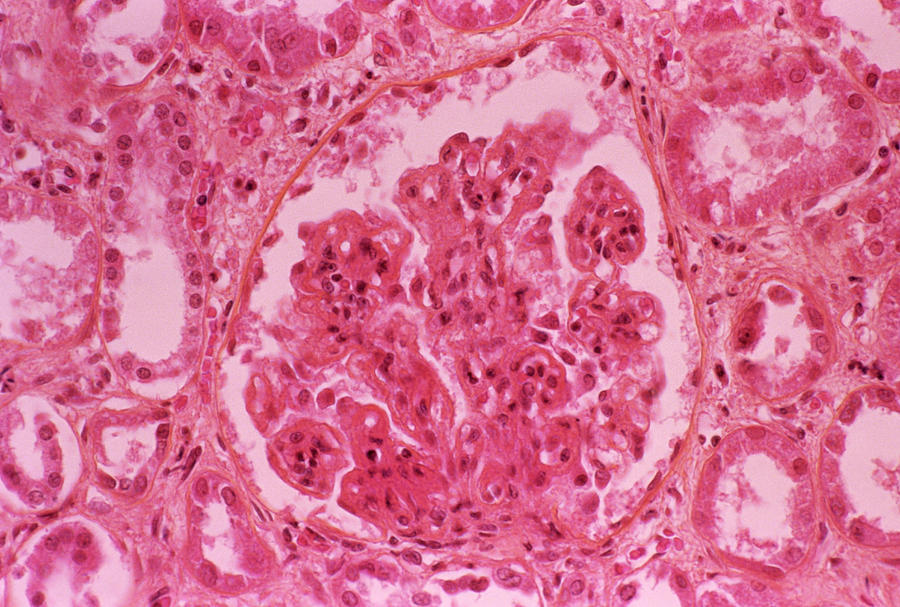 Kidney Tissue Damaged By Immune System Photograph by Cnri/science Photo Library