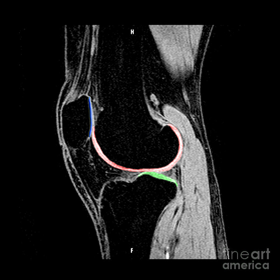 Knee Hyaline Articular Cartilage Photograph by Living Art Enterprises