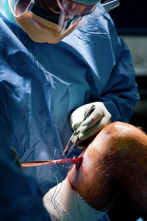 Knee Ligament Repair Surgery Photograph by Jim Varney/science Photo Library