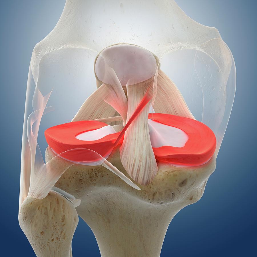 Knee Pain Photograph by Springer Medizin/science Photo Library
