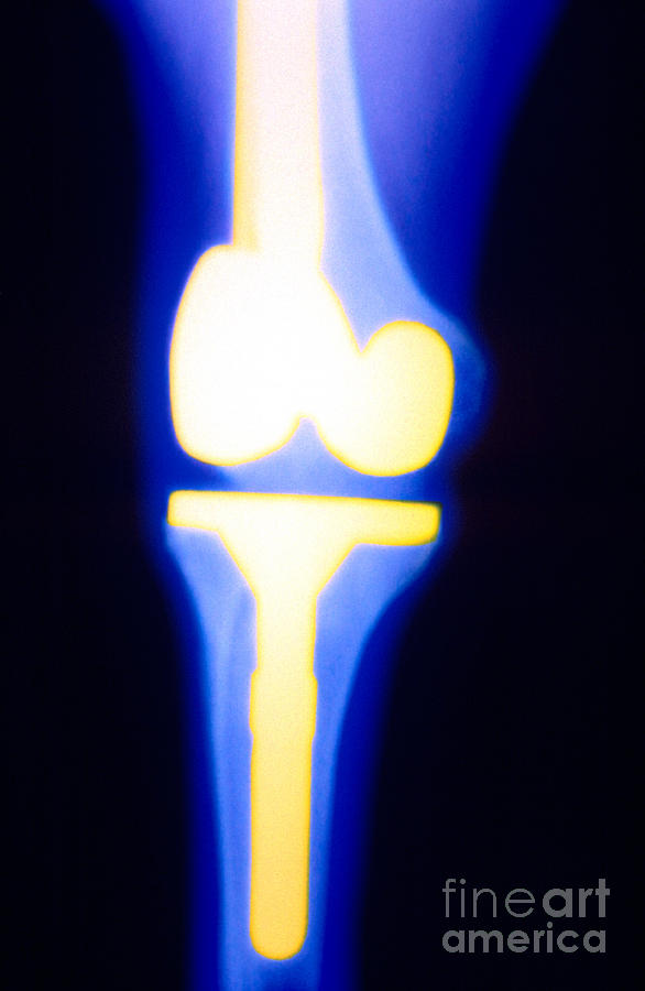 Knee Replacement X-ray Of A 38 Year Old Photograph by Scott Camazine