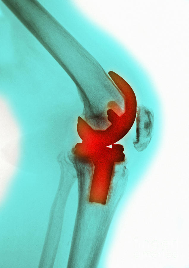 Skeleton Photograph - Knee Replacement, X-ray by Scott Camazine