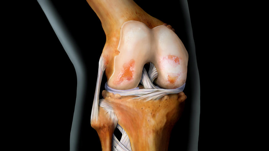 Knee With Arthritis, 3 Of 4 Photograph by Anatomical Travelogue