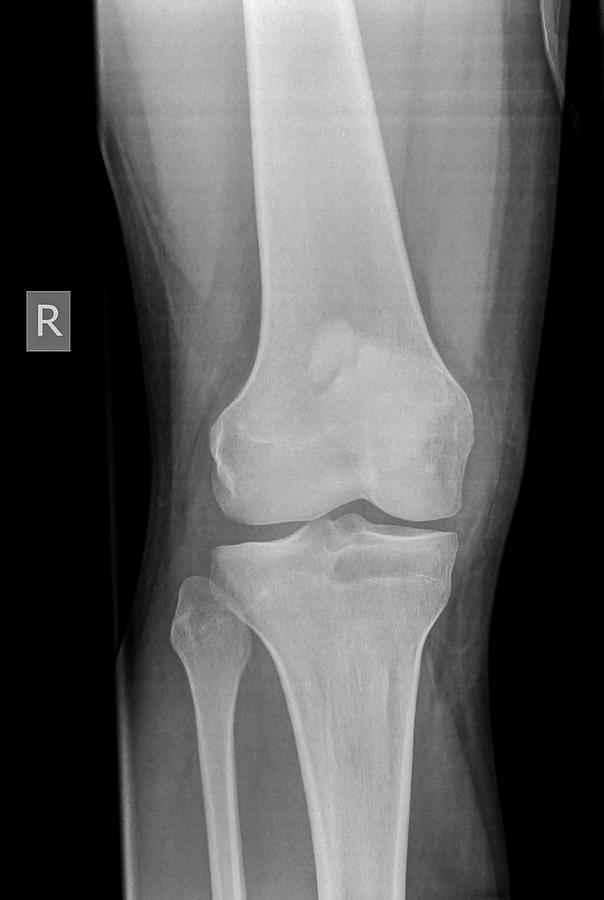 Skeleton Photograph - Knee X-ray by Photostock-israel