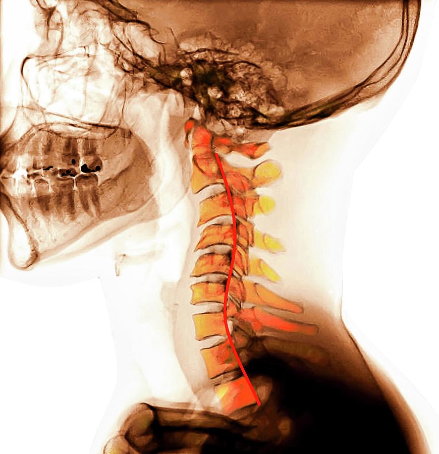 Kyphosis Of The Cervical Spine Medical Media Images  Science Photo Library 