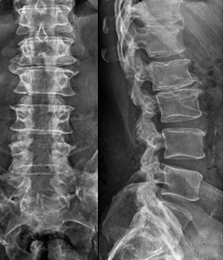 Laminectomy For Spinal Stenosis By Science Photo Library