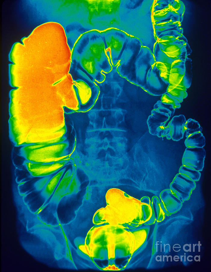 Medical Photograph - Large And Small Intestine, Barium X-ray by Scott Camazine