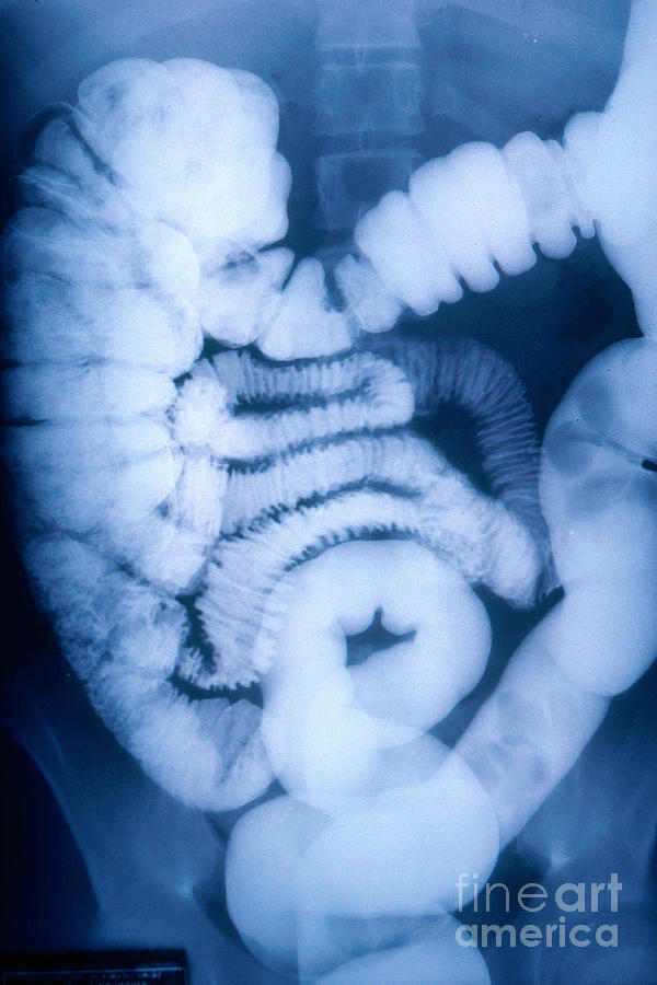 Medical Photograph - Large And Small Intestine, Barium X-ray by Susan Leavines