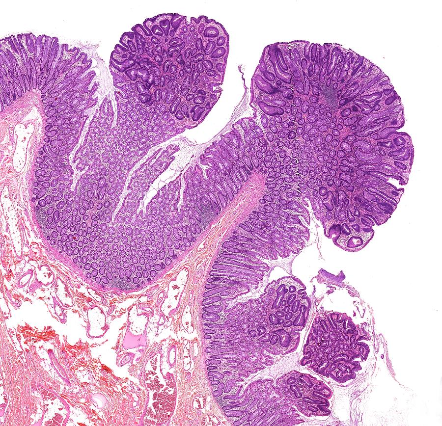 Bowel Photograph - Large Bowel Polyps by Microscape