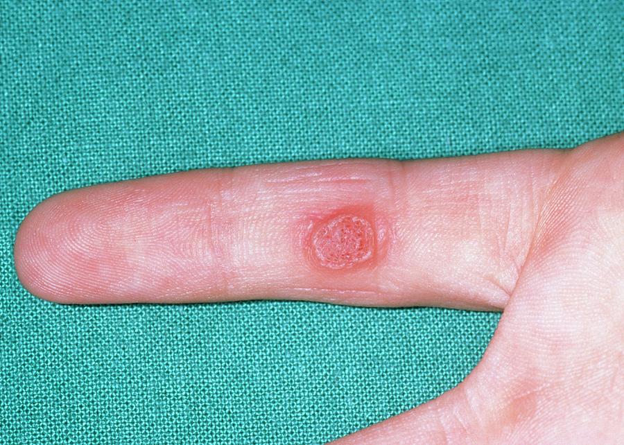 Large Common Wart On The Finger Photograph By Dr P Marazziscience