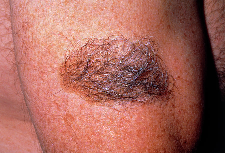 Large Hairy Birthmark Beckers Naevus On Arm Photograph By Dr H C