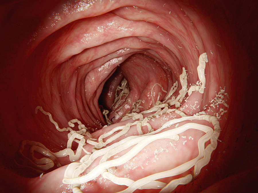Large Roundworm In Human Intestines Photograph by Juan Gaertner