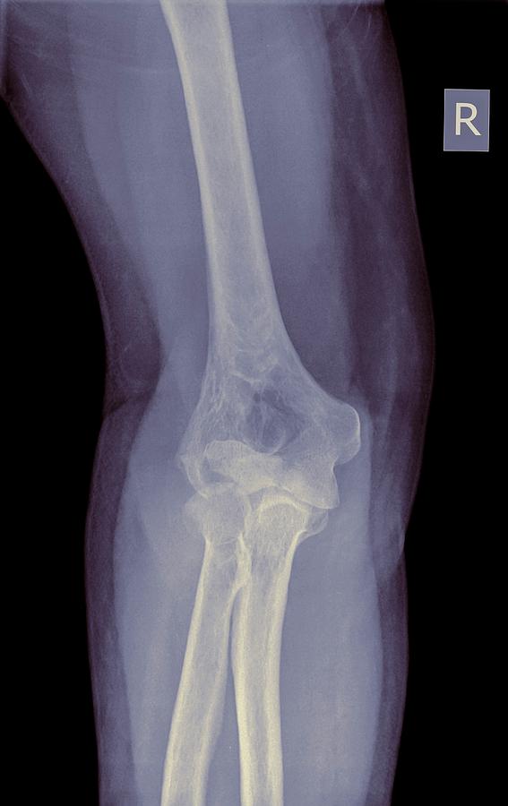 Skeleton Photograph - Leg by Photostock-israel