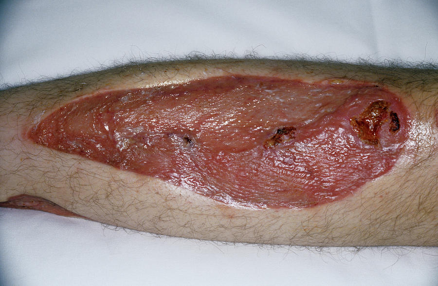 Skin Graft Photograph - Leg Skin Graft by Mike Devlin/science Photo Library