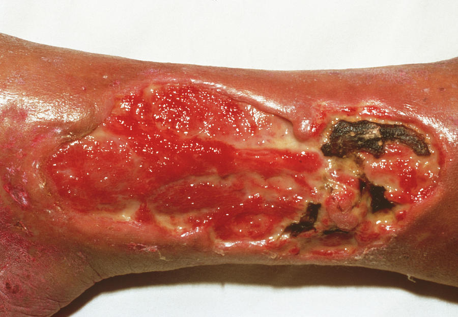Leg Ulcer Photograph by Cnri/science Photo Library