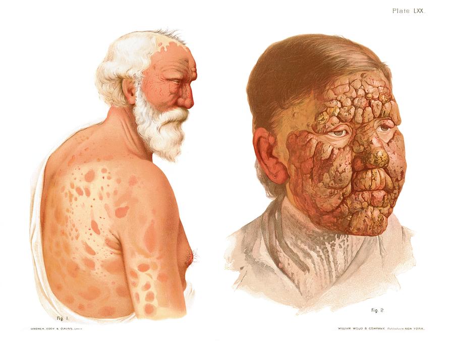 Leprosy Photograph by Us National Library Of Medicine/science Photo Library