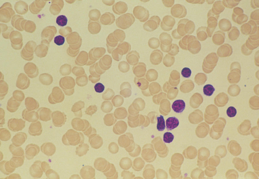 Chronic Lymphocytic Leukemia Photograph - Leukaemia by Astrid & Hanns-frieder Michler/science Photo Library Chronic Lymphocytic Leukemia Photograph - Leukaemia by Astrid & Hanns-frieder Michler/science Photo Library