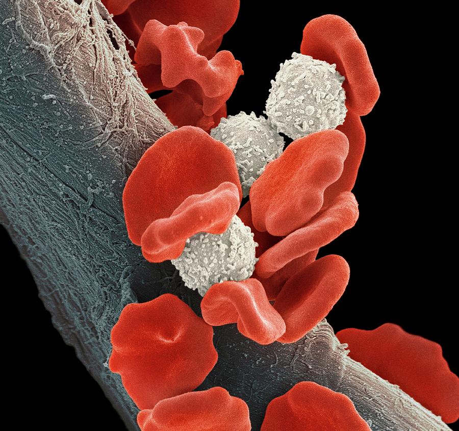 Leukaemia Blood Cells Photograph by Steve Gschmeissner