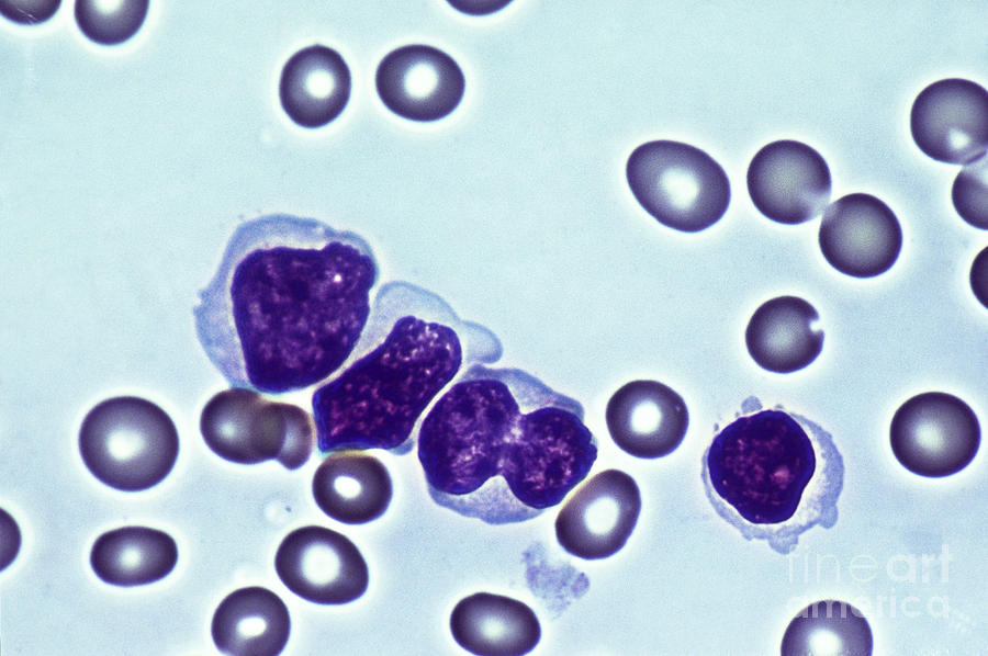 Lymphocyte Photograph - Leukemia by Biology Pics