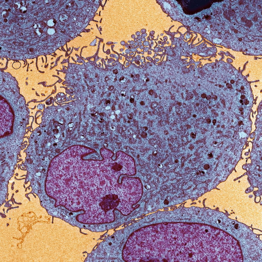 Leukemia cells Photograph by Science Photo Library - STEVE GSCHMEISSNER.