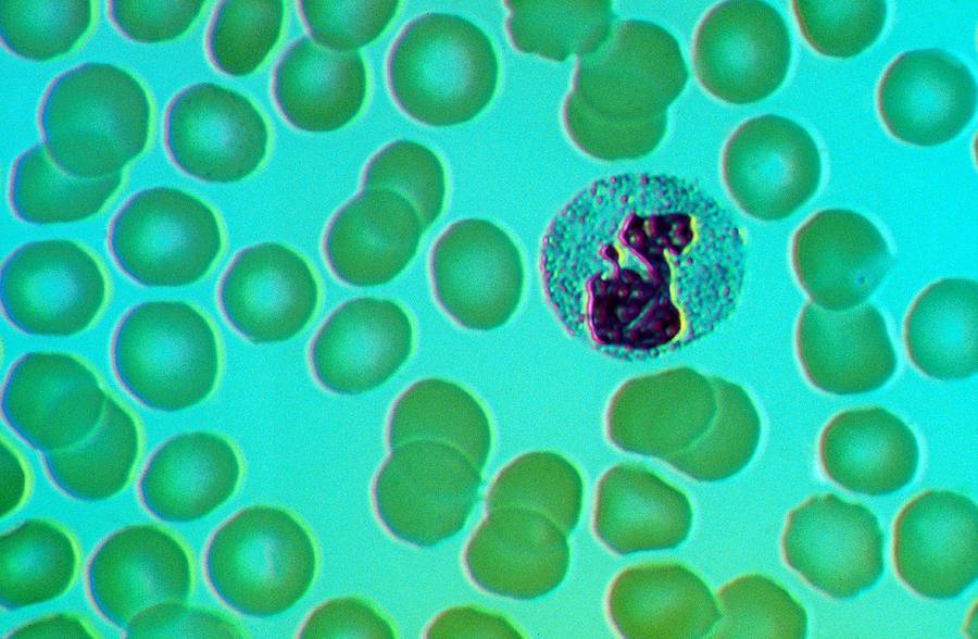 Leukocyte, Drumstick Dic Photograph by Michael Abbey