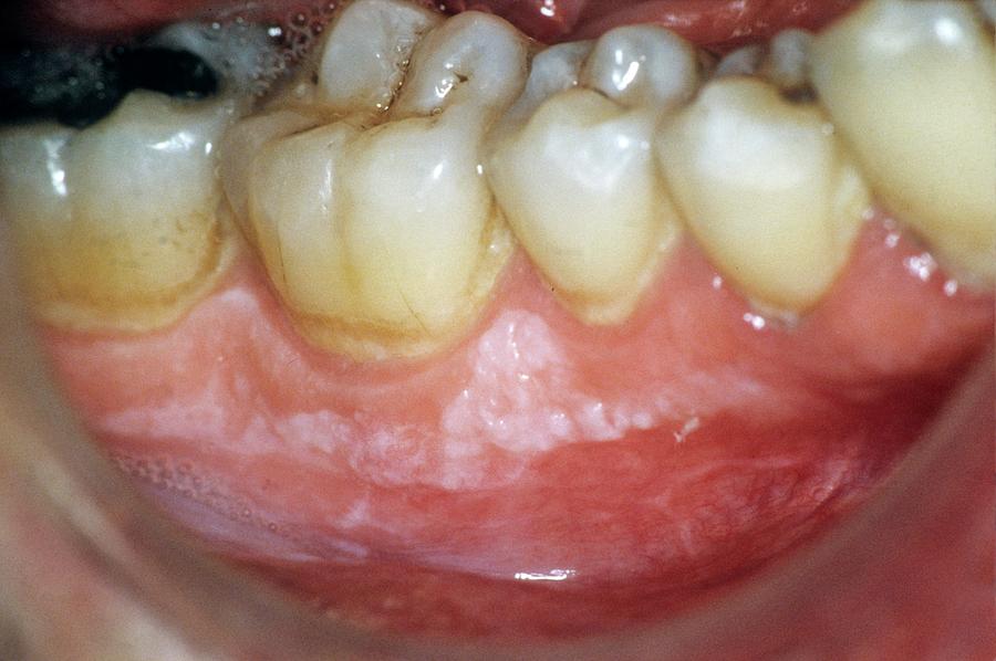 Unhealthy Lower Gums