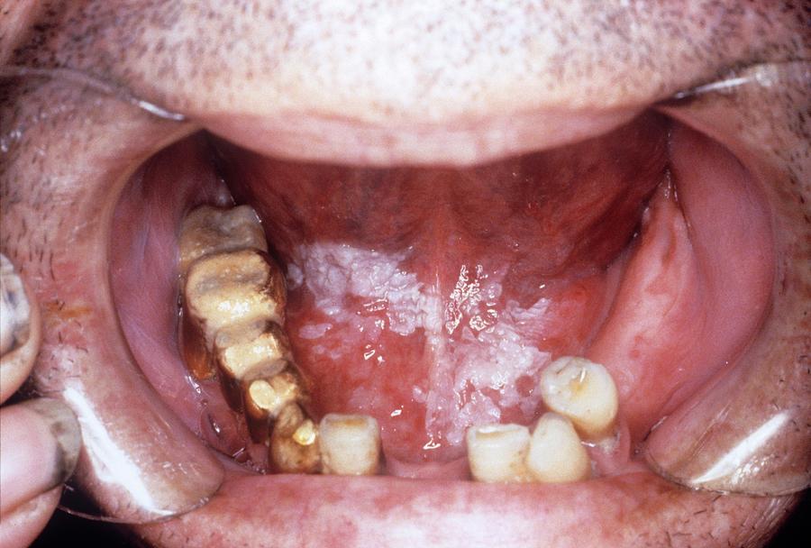 Leukoplakia Of The Mouth Photograph By Clinica Clarosscience Photo
