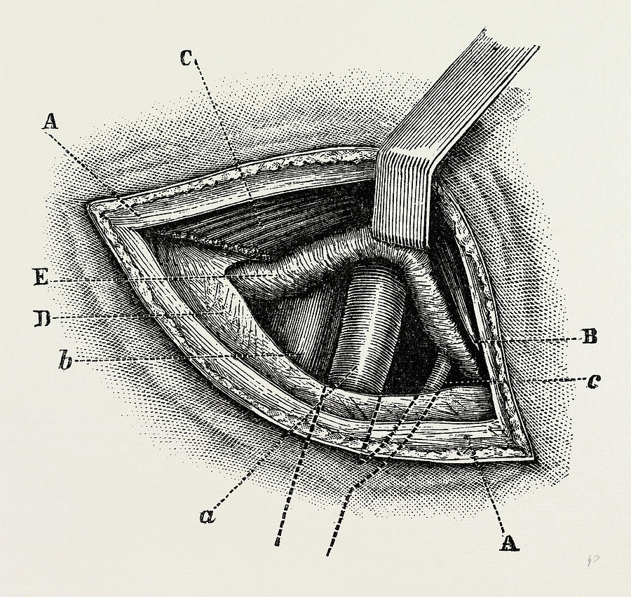 Ligature Of Right External Iliac Artery, Medical Equipment Drawing by Litz Collection Pixels