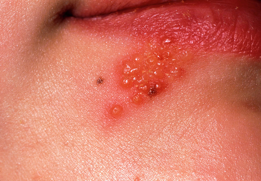 lip-blisters-due-to-the-herpes-simplex-virus-photograph-by-dr-p