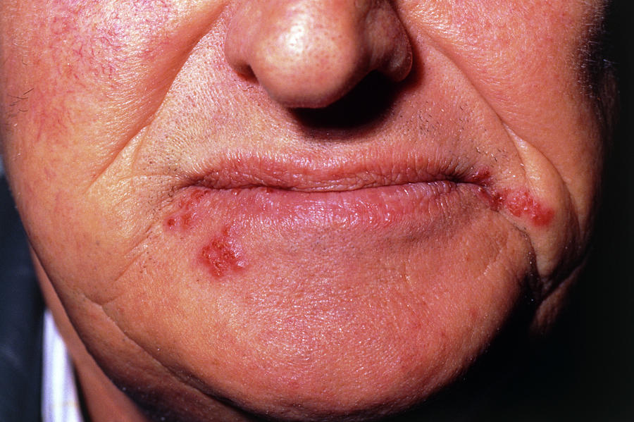 lips-infected-by-the-herpes-simplex-virus-photograph-by-dr-h-c-robinson