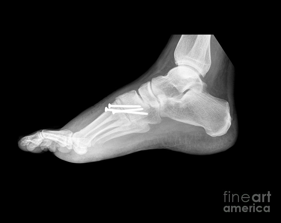 Lisfrance Injury, X-ray Photograph by Living Art Enterprises