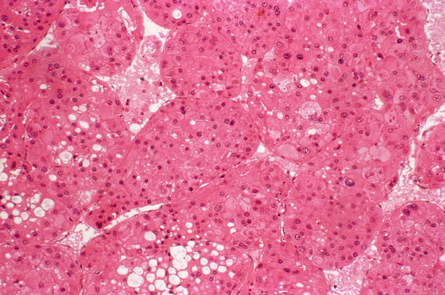 Liver Cancer Photograph by Cnri/science Photo Library